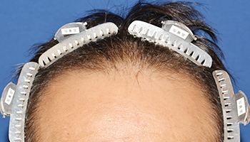 40代 男性 T.K.さん  生え際 前頭部 自毛植毛（MIRAI法） 2,000株の症例（施術前）