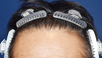 40代 男性 T.K.さん  生え際 前頭部 自毛植毛（MIRAI法） 2,000株の症例（施術後）