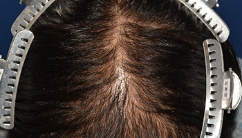 20代 男性 S.Y.さん  前頭部 頭頂部 自毛植毛（MIRAI法） 2,400株｜自毛植毛の症例（施術前）