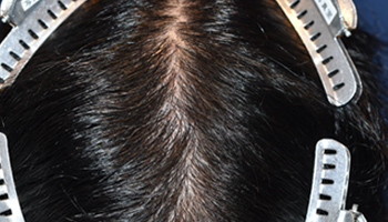 20代 男性 S.Y.さん  前頭部 頭頂部 自毛植毛（MIRAI法） 2,400株｜自毛植毛の症例（施術後）
