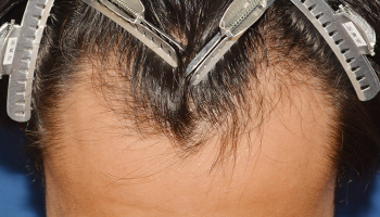 30代 男性 K.T.さん  生え際 自毛植毛（MIRAI法） 1,200株の症例（施術前）
