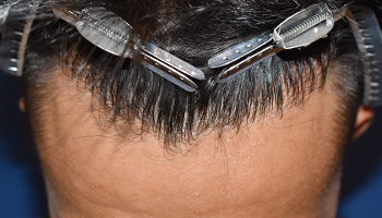 30代 男性 K.T.さん  生え際 自毛植毛（MIRAI法） 1,200株の症例（施術後）
