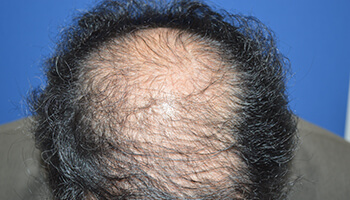 50代 男性 I.N.さん 生え際・頭頂部の自毛植毛（MIRAI法） 3,000株の症例（施術前）