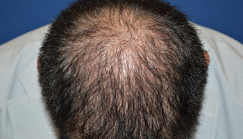 50代 男性 I.N.さん 生え際・頭頂部の自毛植毛（MIRAI法） 3,000株の症例（施術後）