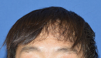 40代 男性 S.A.さん　生え際 自毛植毛（MIRAI法） 1,800株の症例（施術後）