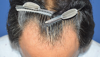 40代 男性 F.Y.さん　生え際 自毛植毛（MIRAI法） 2,000株の症例（施術前）
