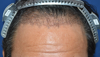 40代 男性 F.Y.さん　生え際 自毛植毛（MIRAI法） 2,000株の症例（3ヶ月）