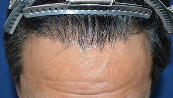 40代 男性 F.Y.さん　生え際 自毛植毛（MIRAI法） 2,000株の症例（6ヶ月）