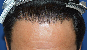 40代 男性 F.Y.さん　生え際 自毛植毛（MIRAI法） 2,000株の症例（9ヶ月）