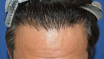 40代 男性 F.Y.さん　生え際 自毛植毛（MIRAI法） 2,000株の症例（1年）