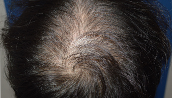 20代 男性 M.A.さん  生え際・頭頂部 自毛植毛（MIRAI法） 1,833株の症例（施術前）