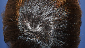 20代 男性 M.A.さん  生え際・頭頂部 自毛植毛（MIRAI法） 1,833株の症例（施術後）