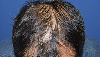 50代 男性 F.K.さん  生え際・頭頂部 自毛植毛（MIRAI法） 1,600株の症例（施術前）