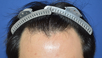 20代 男性 G.S.さん  生え際 自毛植毛（MIRAI法） 1,700株の症例（施術前）