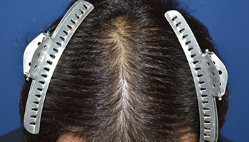 30代 男性 W.T.さん 生え際 頭頂部 自毛植毛（MIRAI法） 1,500株｜自毛植毛の症例（施術前）_頭頂部
