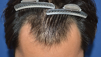 30代 男性 W.T.さん  生え際 頭頂部 自毛植毛（MIRAI法） 1,500株｜自毛植毛の症例（施術前）