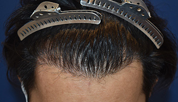 30代 男性 W.T.さん  生え際 頭頂部 自毛植毛（MIRAI法） 1,500株｜自毛植毛の症例（施術後）