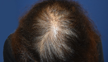 20代 女性 M.T.さん  頭頂部 自毛植毛（MIRAI法） 1,000株の症例（施術前）