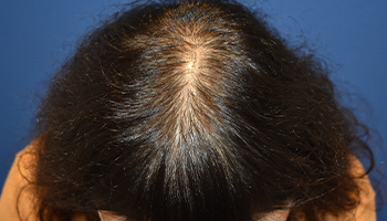 20代 女性 M.T.さん  頭頂部 自毛植毛（MIRAI法） 1,000株の症例（施術後）
