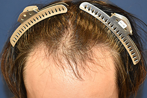 30代 男性 K.Y.さん  生え際 自毛植毛（MIRAI法） 2,000株の症例（施術前）