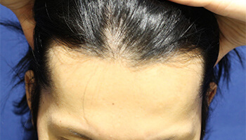 20代 男性 S.K.さん　生え際 自毛植毛（MIRAI法） 1,400株の症例（施術前）