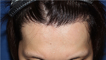 20代 男性 S.K.さん　生え際 自毛植毛（MIRAI法） 1,400株の症例（施術後）