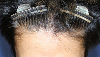 20代 男性 T.R.さん　生え際・前頭部・頭頂部 自毛植毛（MIRAI法） 2,000株の症例（施術前）