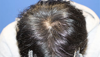 20代 男性 T.R.さん　生え際・前頭部・頭頂部 自毛植毛（MIRAI法） 2,000株の症例（施術前）