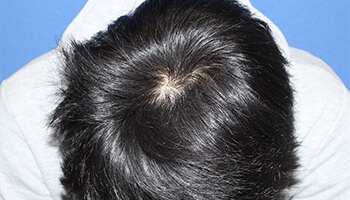 20代 男性 T.R.さん　生え際・前頭部・頭頂部 自毛植毛（MIRAI法） 2,000株の症例（施術後）