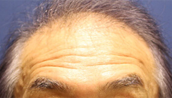 60代 男性 O.S.さん　前頭部・頭頂部 自毛植毛（MIRAI法） 2,700株の症例（施術前）