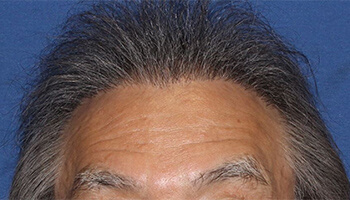 60代 男性 O.S.さん　前頭部・頭頂部 自毛植毛（MIRAI法） 2,700株の症例（施術後）