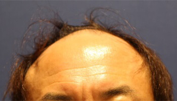 40代 男性 S.R.さん　生え際・前頭部 自毛植毛（MIRAI法） 1,500株の症例（施術前）