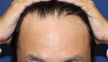 40代 男性 O.T.さん　生え際・前頭部 自毛植毛（MIRAI法） 1,700株の症例（施術前）