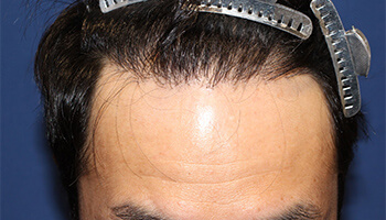 40代 男性 O.T.さん　生え際・前頭部 自毛植毛（MIRAI法） 1,700株の症例（施術後）