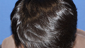 40代 男性 O.T.さん　生え際・前頭部 自毛植毛（MIRAI法） 1,700株の症例（施術後）