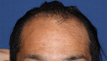 30代 男性 S.T.さん　生え際 自毛植毛（MIRAI法） 1,900株の症例（施術前）
