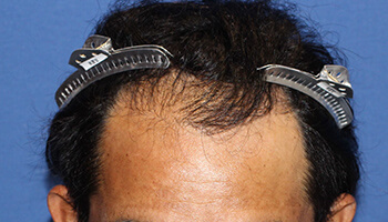 30代 男性 S.T.さん　生え際 自毛植毛（MIRAI法） 1,900株の症例（施術後）