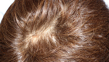 50代 男性 K.T.さん　頭頂部・つむじ 自毛植毛（NC-MIRAI法） 500株の症例（施術前）