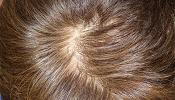 50代 男性 K.T.さん　頭頂部・つむじ 自毛植毛（NC-MIRAI法） 500株の症例（施術後）