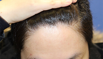 30代 男性 K.R.さん　生え際・前頭部 自毛植毛（NC-MIRAI法） 1,200株の症例（施術前）