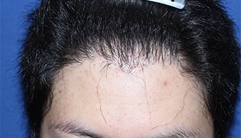 30代 男性 K.R.さん　生え際・前頭部 自毛植毛（NC-MIRAI法） 1,200株の症例（施術後）