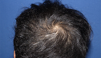 30代 男性 S.H.さん　頭頂部 自毛植毛（MIRAI法） 1,000株の症例（施術前）
