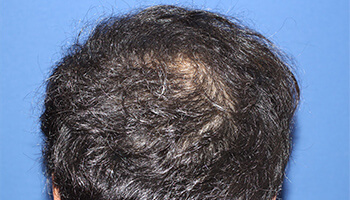 30代 男性 S.H.さん　頭頂部 自毛植毛（MIRAI法） 1,000株の症例（施術後）