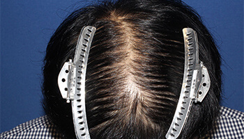 30代 男性 K.H.さん　頭頂部 自毛植毛（NC-MIRAI法） 1,421株の症例（施術前）