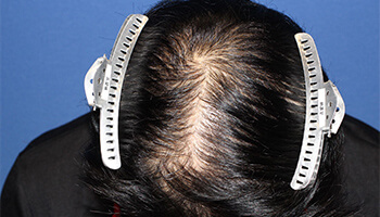 30代 男性 K.H.さん　頭頂部 自毛植毛（NC-MIRAI法） 1,421株の症例（施術後）