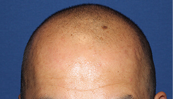 40代 男性 U.A.さん　生え際、前頭部、頭頂部 自毛植毛（MIRAI法） 3,000株の症例（施術前）