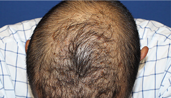40代 男性 U.A.さん　生え際、前頭部、頭頂部 自毛植毛（MIRAI法） 3,000株の症例（施術後）