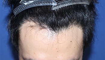 20代 男性 S.A.さん　生え際 自毛植毛（MIRAI法）800株の症例（施術後）