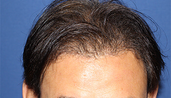 40代 男性 D.S.さん　生え際 自毛植毛（MIRAI法） 2,000株の症例（施術後）