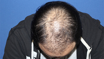 30代 男性 H.Y.さん　前頭部・頭頂部 自毛植毛（MIRAI法） 2,100株の症例（施術前）